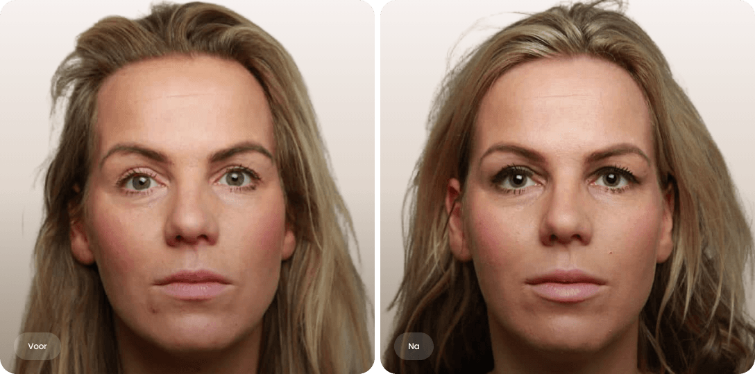 Voor en na foto van fillerbehandeling lippen voor een vollere en mooi gevormde lipvorm bij The Body Clinic