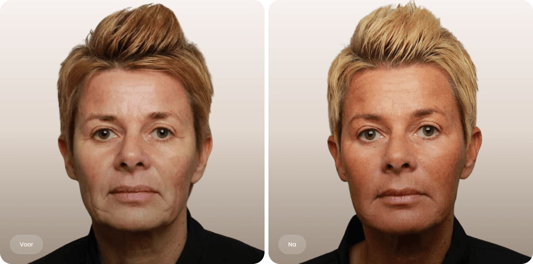 Voor en na foto van liquid facelift met fillers voor hersteld volume en een frissere uitstraling bij The Body Clinic