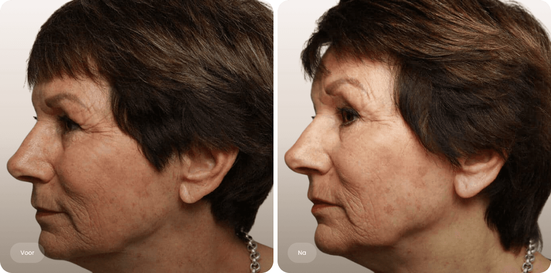 Voor en na foto van fillerbehandeling oorlel voor een vollere en stevigere oorlel bij The Body Clinic