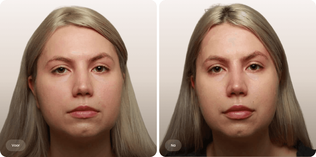 Voor en na foto van fillerbehandeling lippen voor subtiel meer volume en gedefinieerde lippen bij The Body Clinic