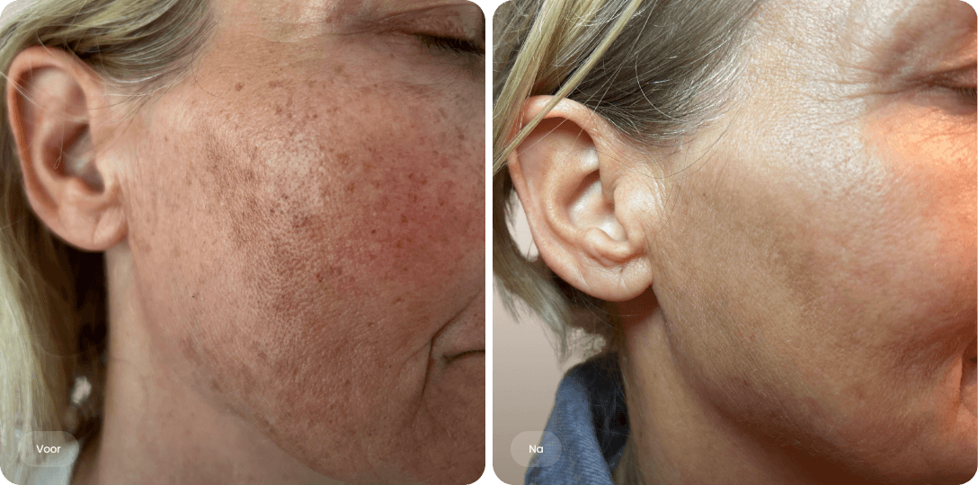 Before and after Voor en na foto van lasertherapie tegen pigmentvlekken op de wang voor een egale en heldere huid bij The Body Clinic of a person's cheek showing improved skin texture and reduced dark spots.