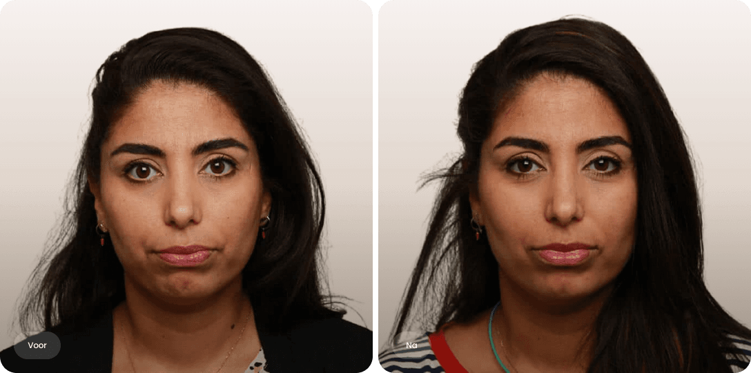 Voor en na foto van botoxbehandeling kin tegen kinlijntjes en putjes bij een vrouw voor een gladde kinhuid bij The Body Clinic