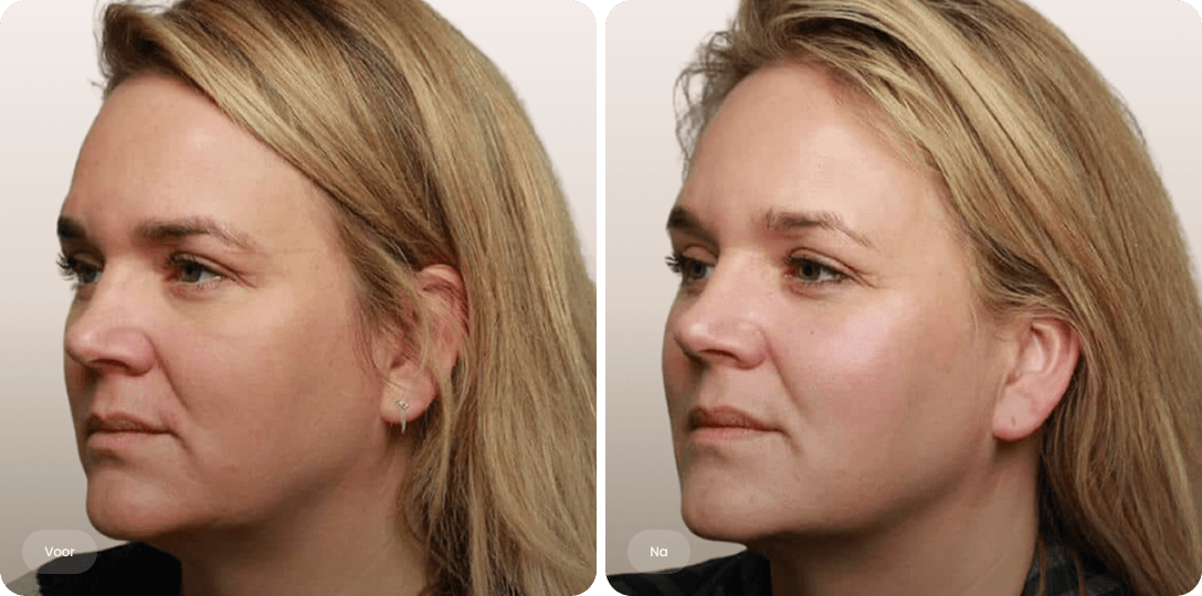 Voor en na foto van fillerbehandeling kaaklijn voor een strakker profiel en gedefinieerde jawline bij The Body Clinic