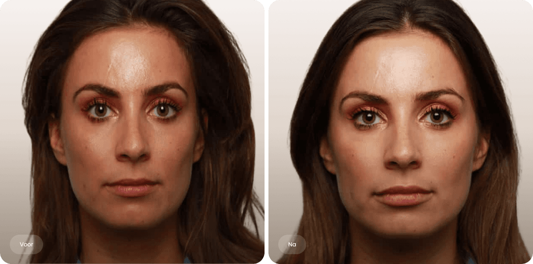 Voor en na foto van fillerbehandeling lippen voor natuurlijk vollere lippen bij The Body Clinic