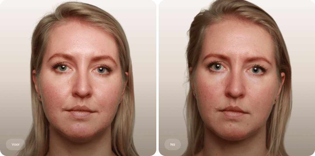Voor en na foto van fillerbehandeling slapen voor hersteld volume en een evenwichtiger gezicht bij The Body Clinic