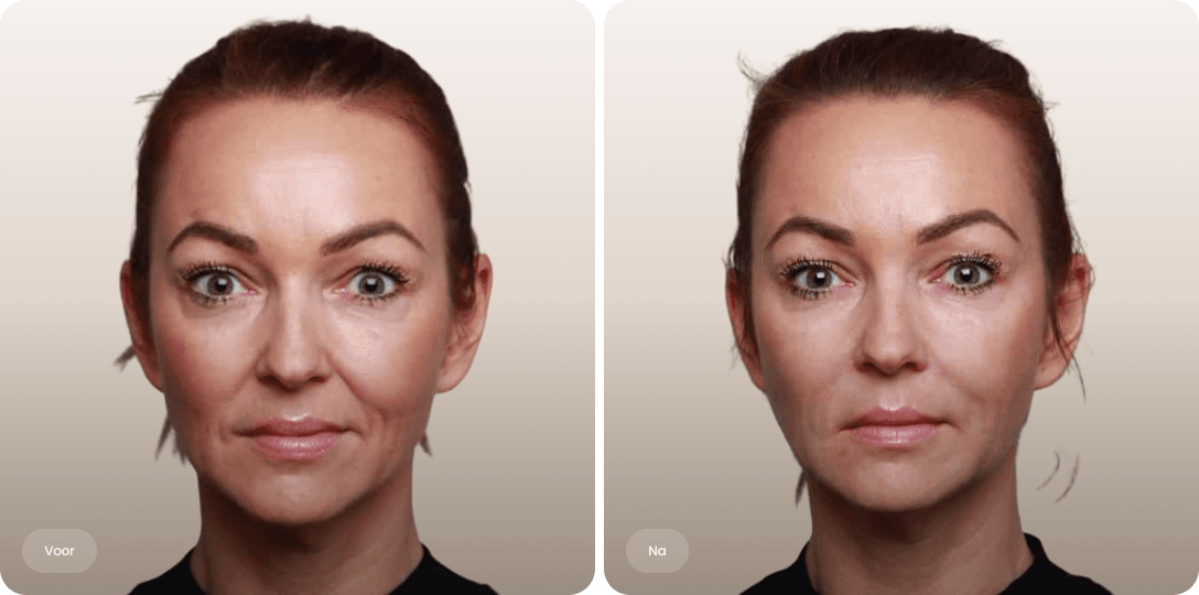Voor en na foto van fillerbehandeling neuslipplooi voor verzachte plooien en een frissere uitstraling bij The Body Clinic