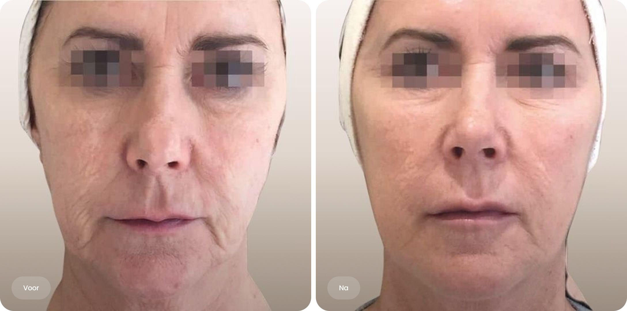 Voor en na resultaat van Profhilo gezichtsbehandeling bij The Body Clinic