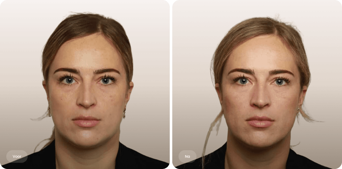 Voor en na foto van fillerbehandeling wallen en traangoot voor een frissere oogopslag bij The Body Clinic