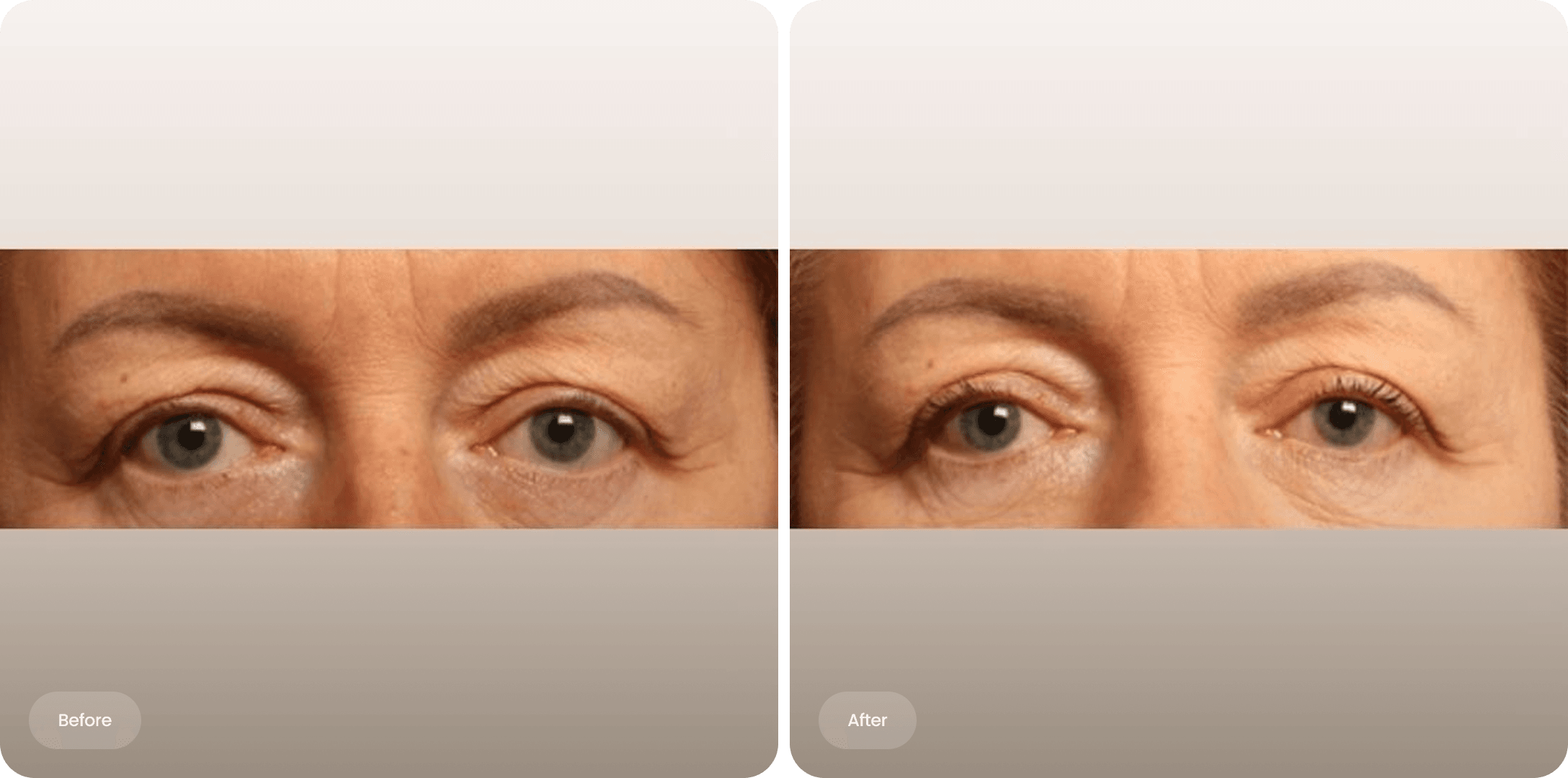 Before and after photo of an upper eyelid correction at The Body Clinic