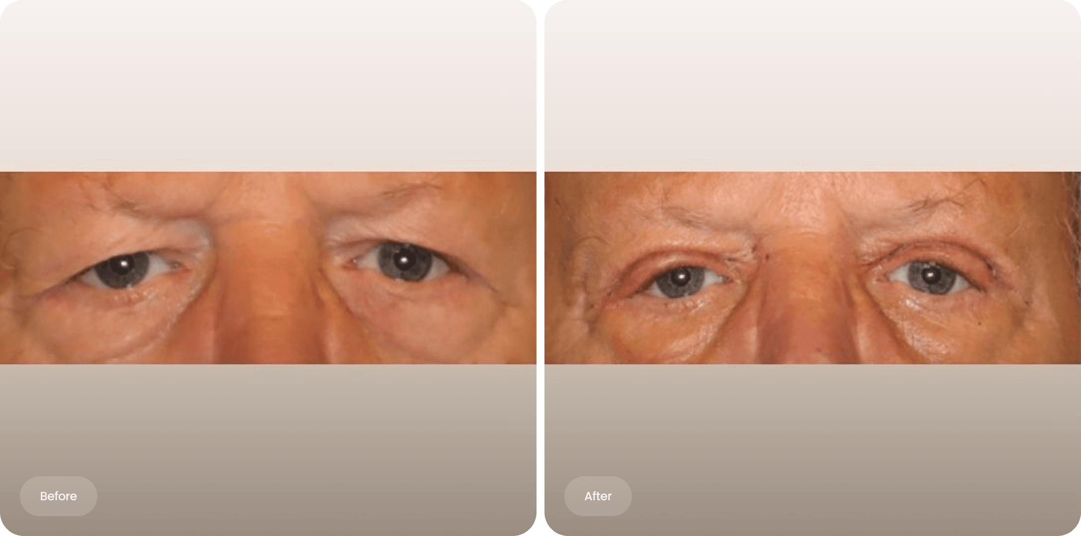 Before and after photo of an upper eyelid correction at The Body Clinic