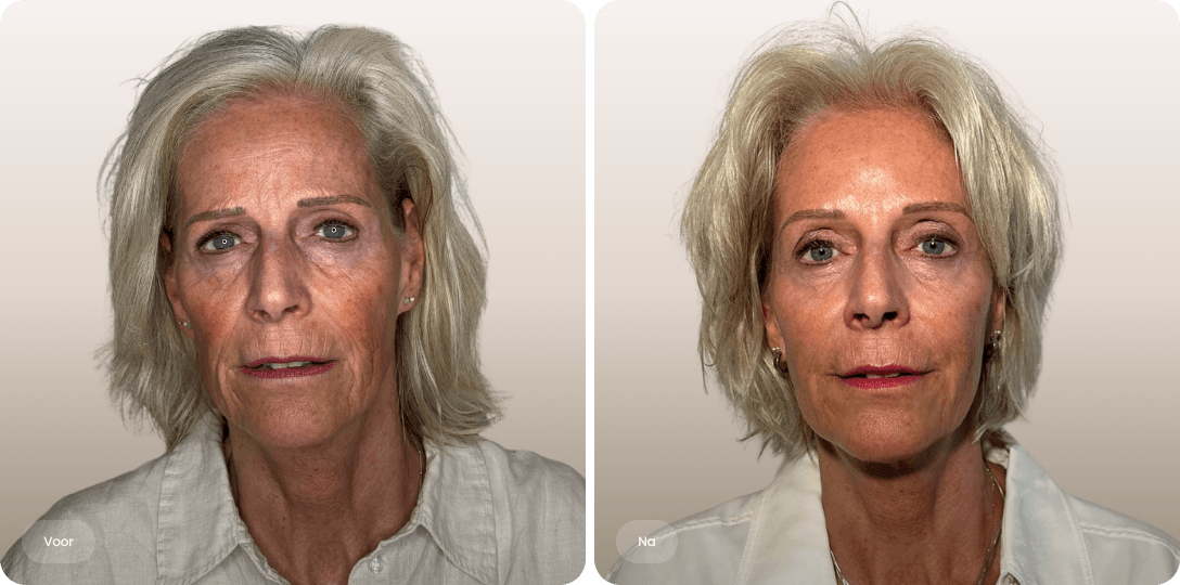 Voor en na foto van liquid facelift met fillers bij een vrouw voor een vitale en frisse uitstraling bij The Body Clinic