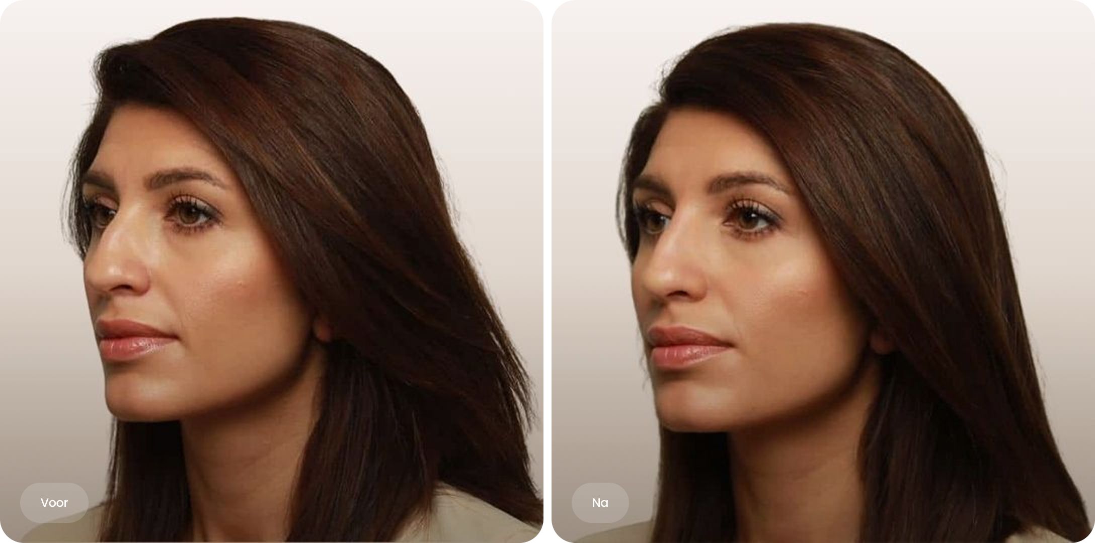 Voor-en-na foto van neus filler behandeling bij The Body Clinic