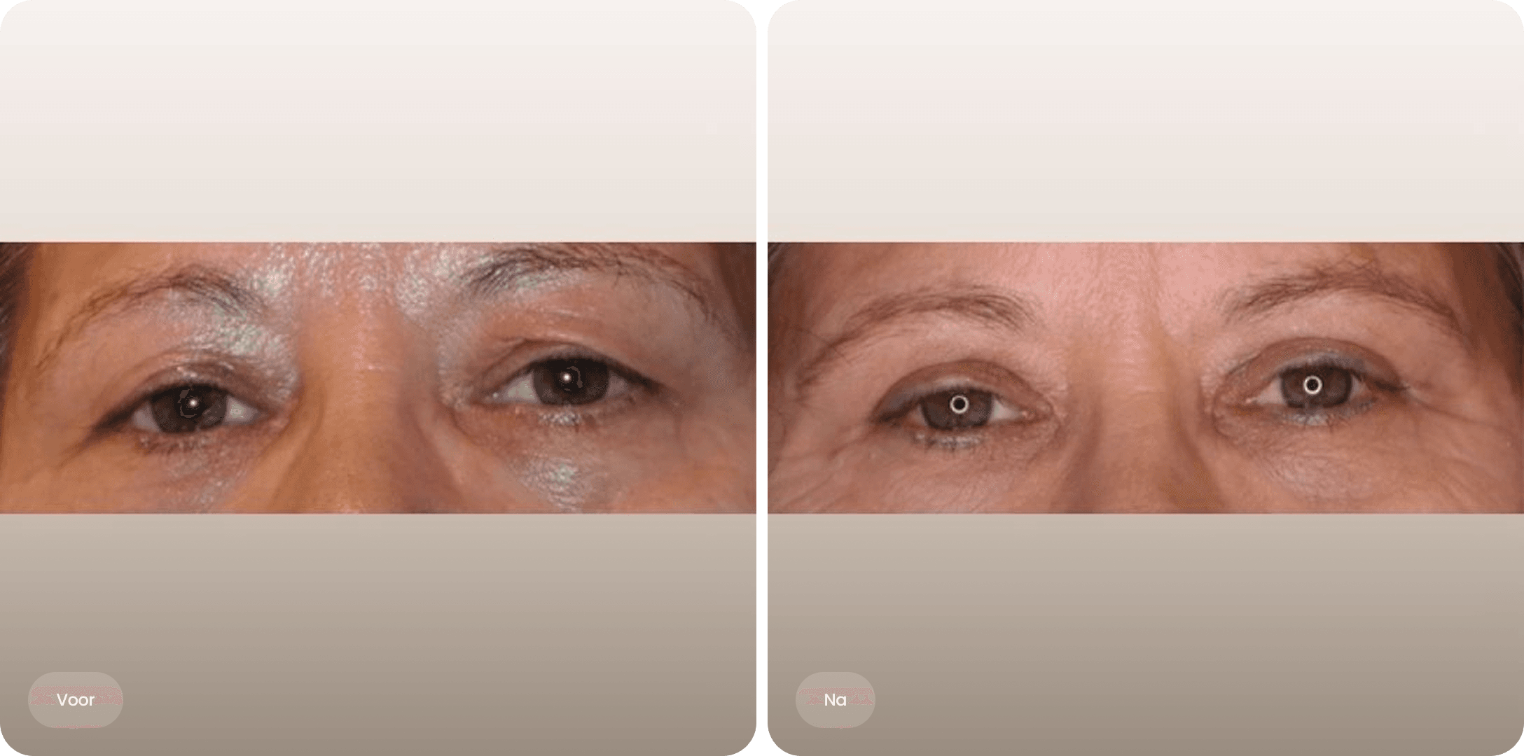 Voor en na foto van een bovenooglidcorrectie bij The Body Clinic