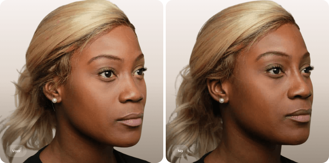 Voor en na foto van neuscorrectie met filler voor een verfijnd en evenwichtig neusprofiel bij The Body Clinic