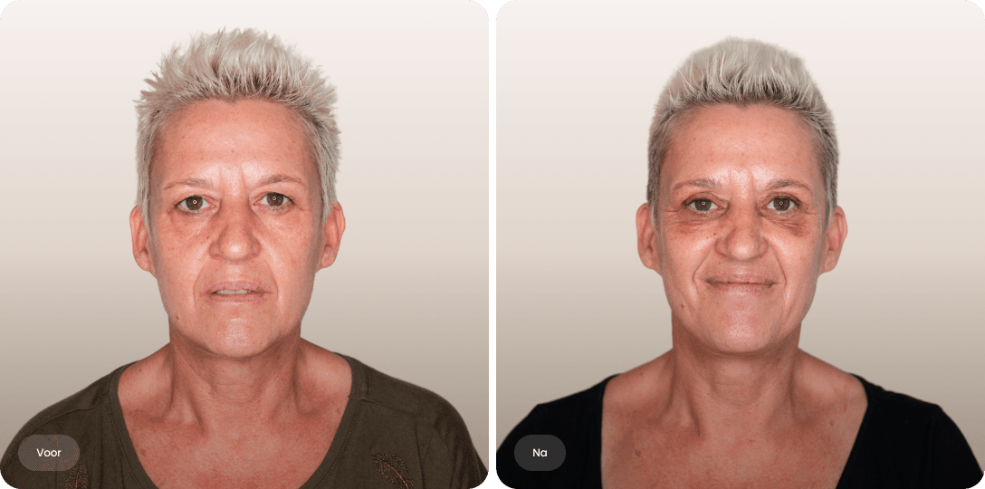 Voor en na foto van ooglidcorrectie bij een vrouw voor een openere blik en minder hangende oogleden bij The Body Clinic