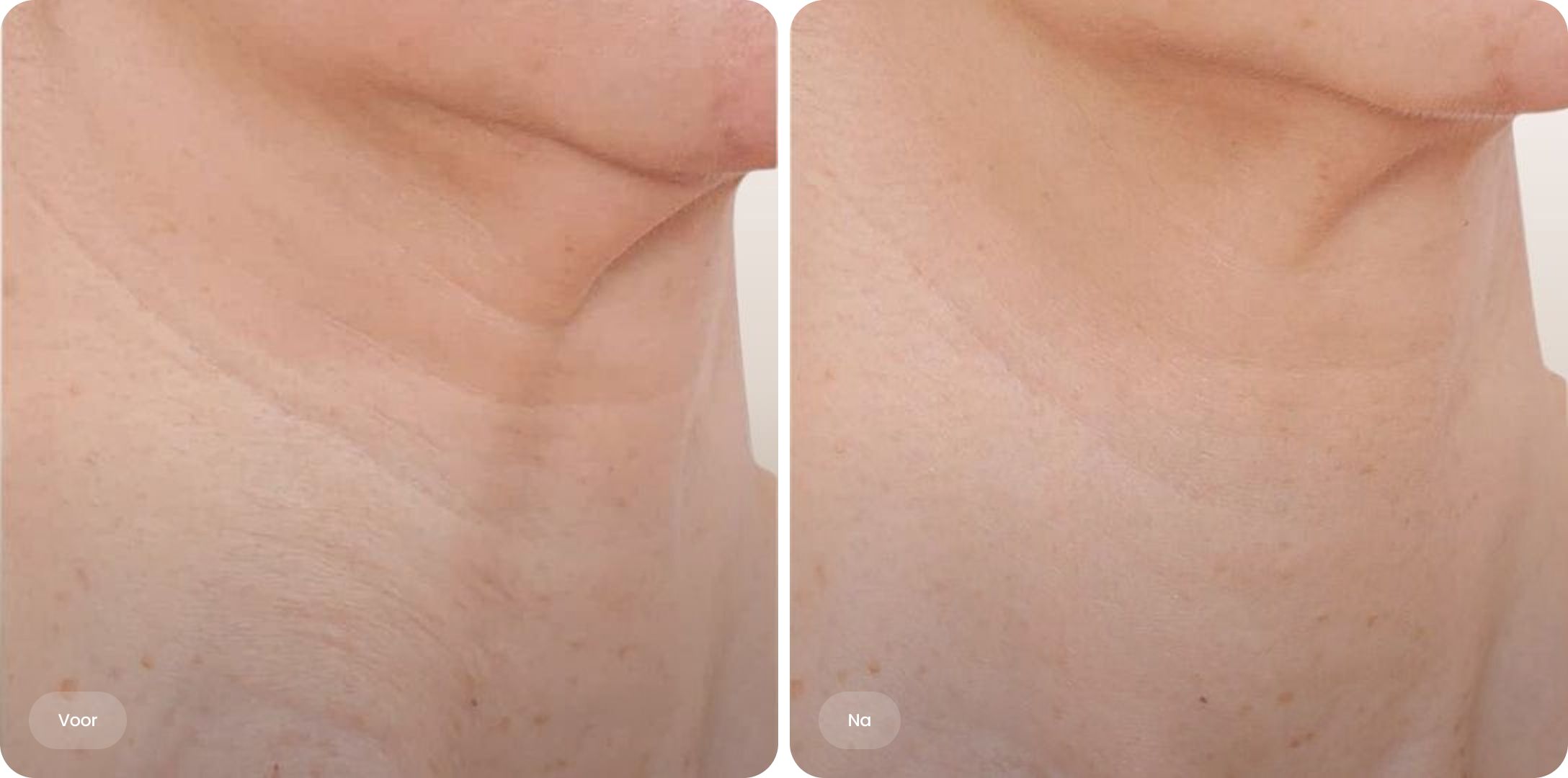 oor en na resultaat van Profhilo behandeling op de hals bij The Body Clinic