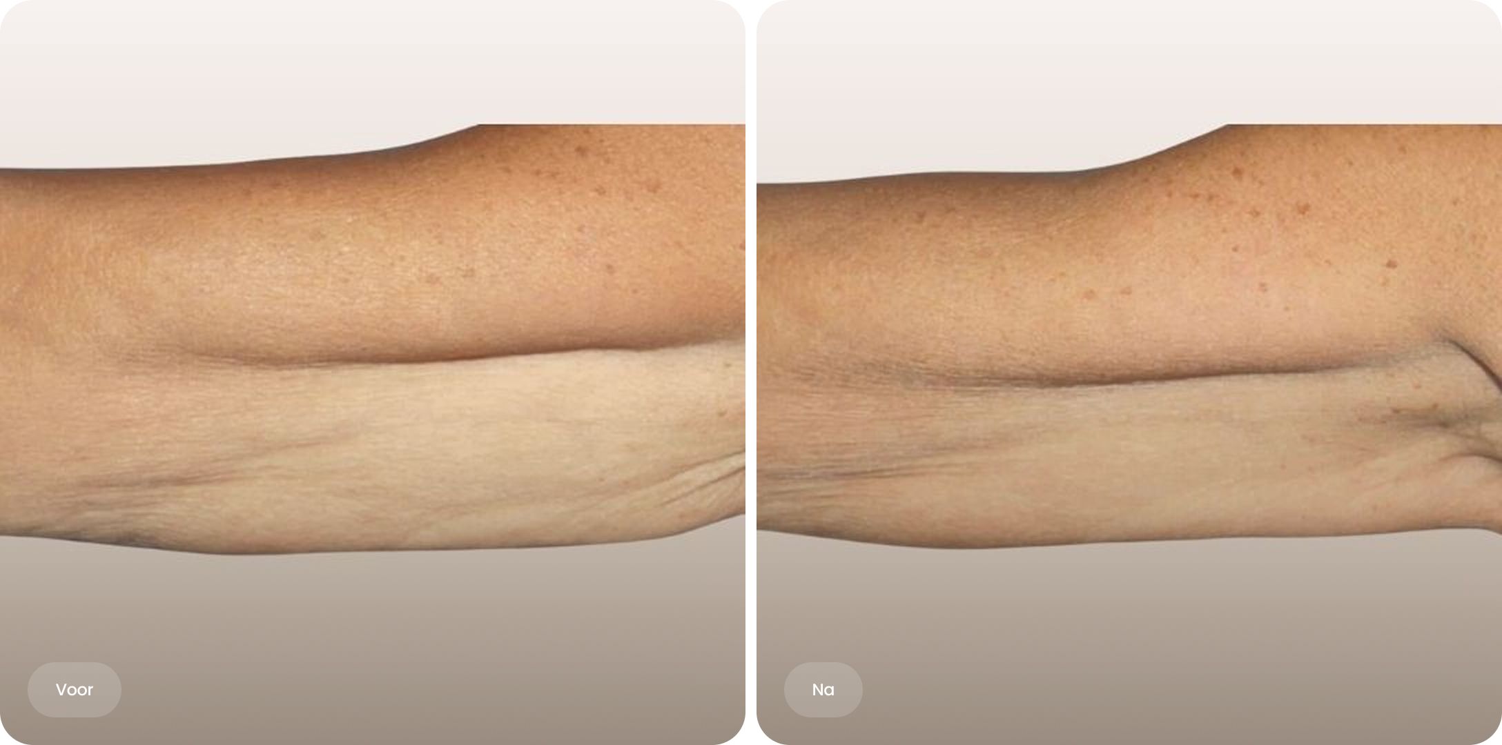 Voor en na resultaat van Profhilo behandeling op de arm bij The Body Clinic