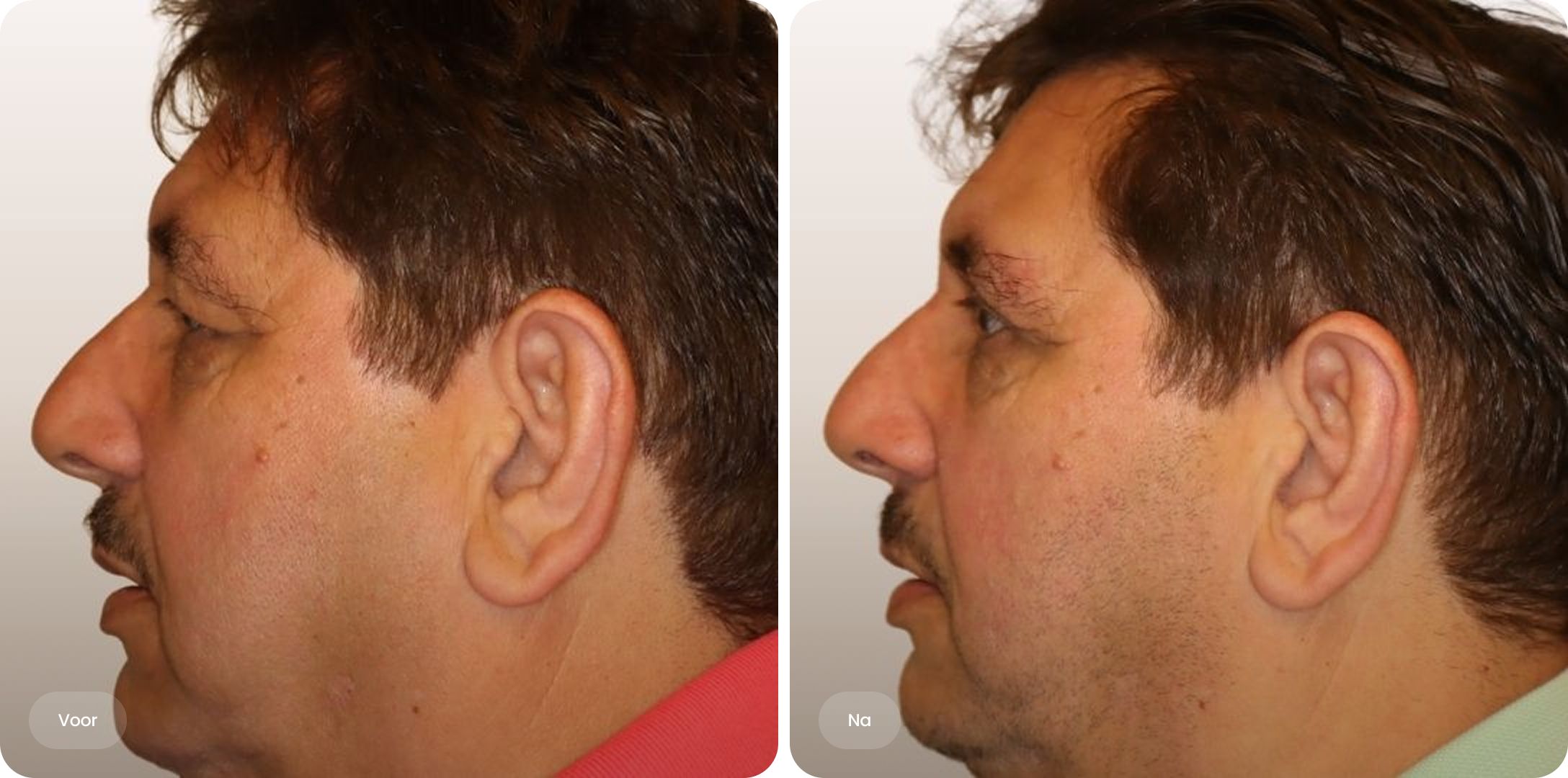 Voor-en-na foto van ooglidcorrectie bij The Body Clinic