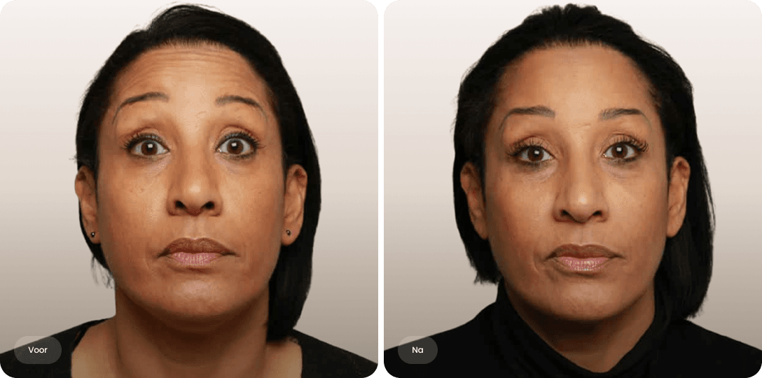 Voor en na foto van botoxbehandeling voorhoofd voor een gladder voorhoofd en minder rimpels bij The Body Clinic