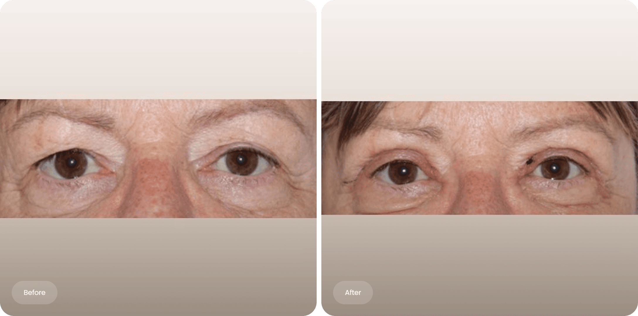 Before and after photo of an upper eyelid correction at The Body Clinic