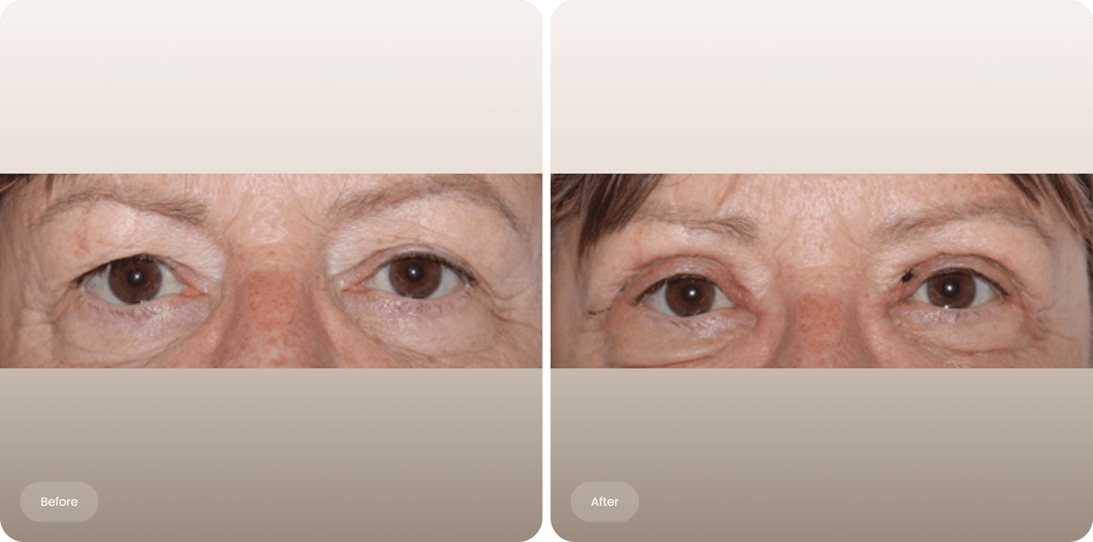 Before and after photo of an upper eyelid correction at The Body Clinic