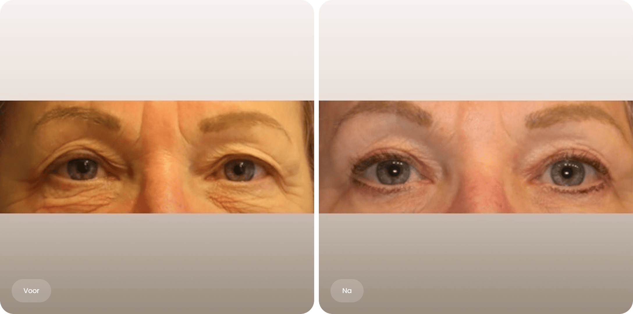 Voor en na foto van een bovenooglidcorrectie bij The Body Clinic