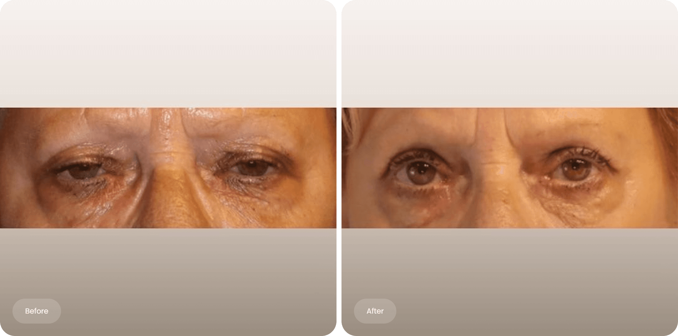 Before and after photo of an upper eyelid correction at The Body Clinic