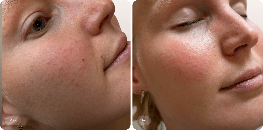 Voor en na foto van lasertherapie tegen couperose voor een egaler huidsbeeld en minder roodheid bij The Body Clinic