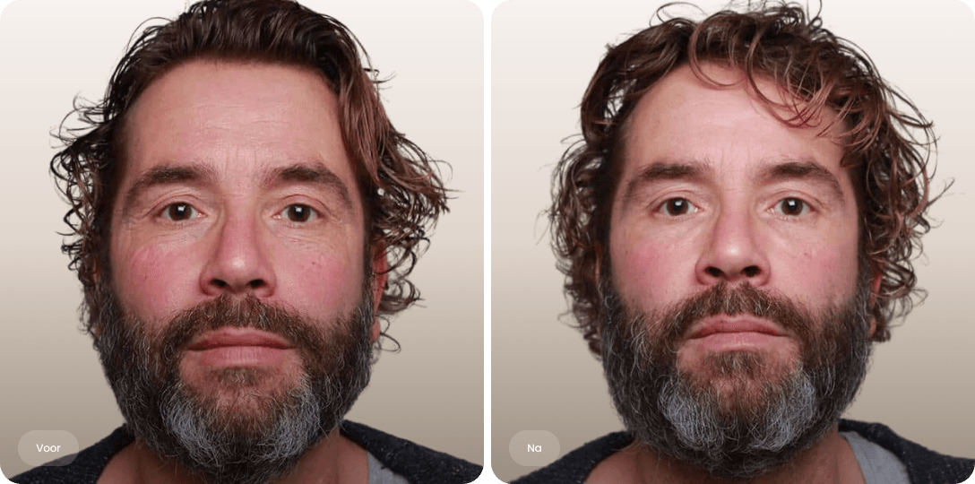 Voor en na foto van fillerbehandeling wallen en traangoot bij een man voor een frissere blik bij The Body Clinic