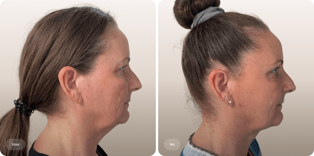 Voor en na foto van NeckTite-behandeling voor een scherpe kaaklijn en strakkere hals bij The Body Clinic