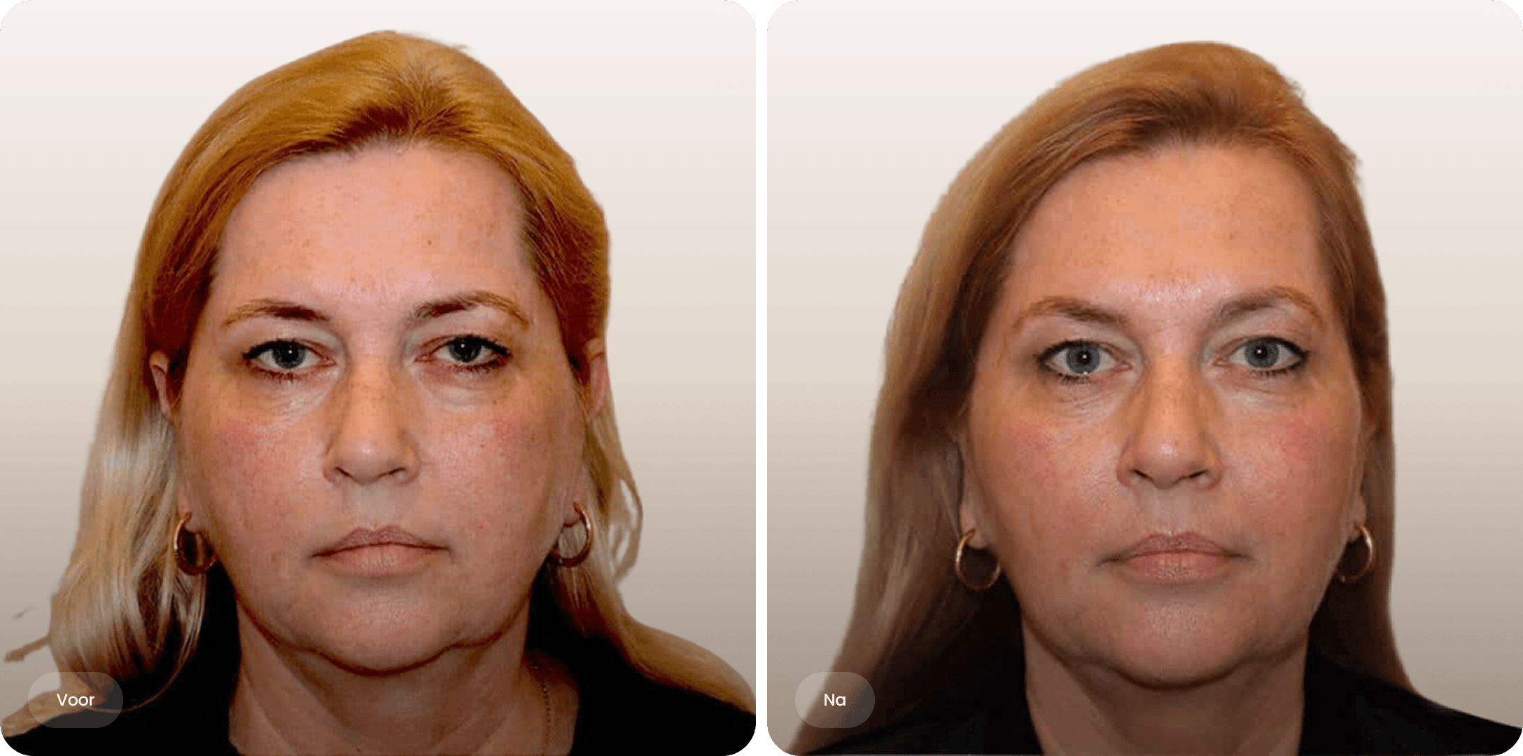 Voor en na foto van liquid facelift met fillers voor een gelift gezicht bij The Body Clinic