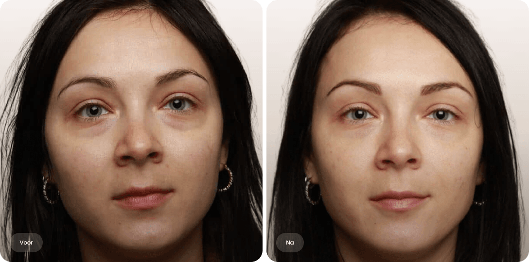 Voor en na foto van fillerbehandeling wallen en traangoot voor minder donkere kringen bij The Body Clinic