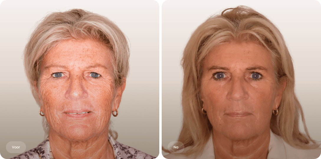 Voor en na foto van ooglidcorrectie bij een vrouw voor een uitgeruste oogopslag en frissere blik bij The Body Clinic