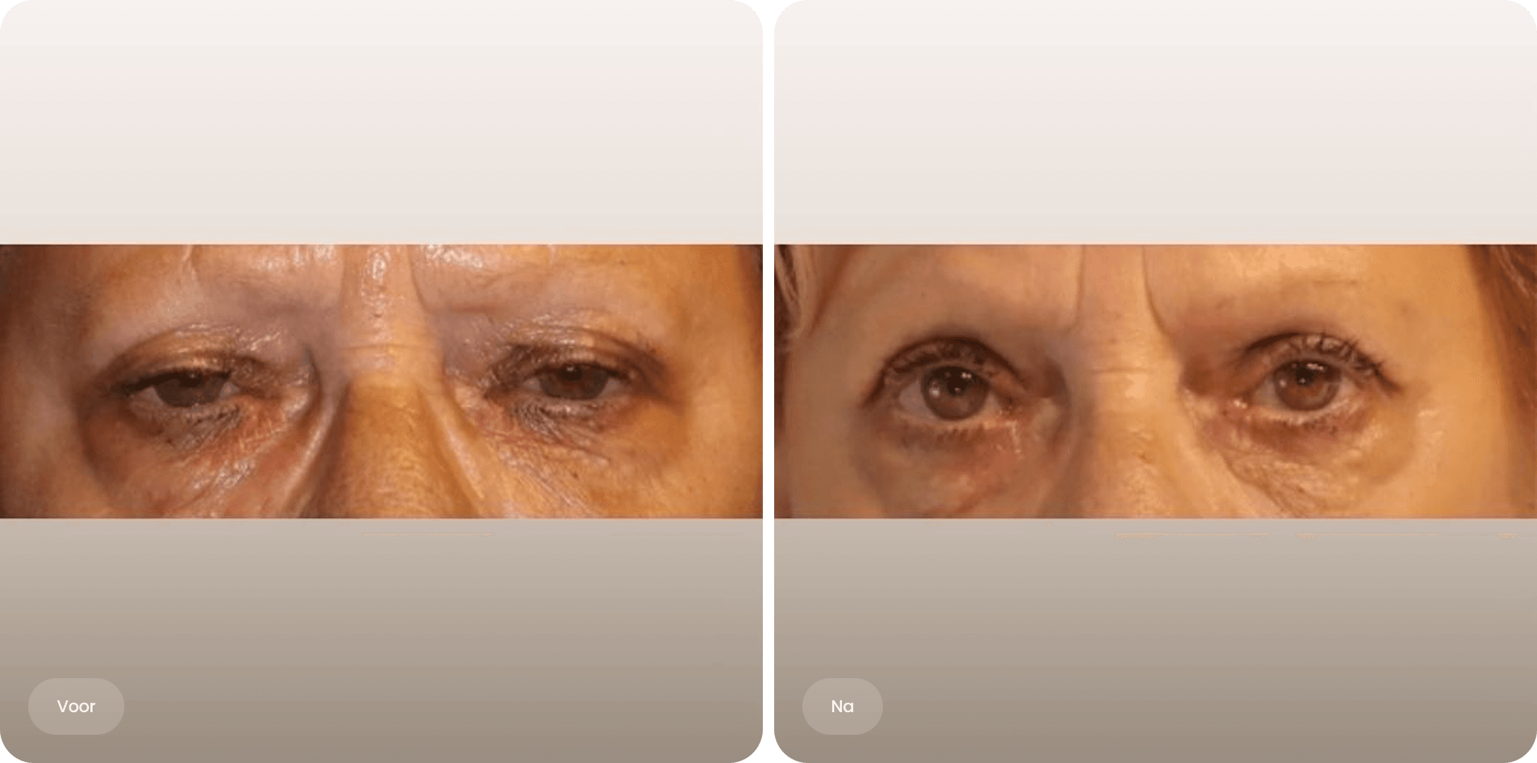 Voor en na foto van een bovenooglidcorrectie bij The Body Clinic