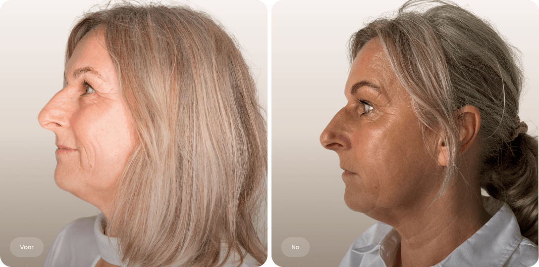 Voor en na foto van Morpheus8-behandeling in het gezicht voor een strakker huidsbeeld en verbeterde huidkwaliteit bij The Body Clinic