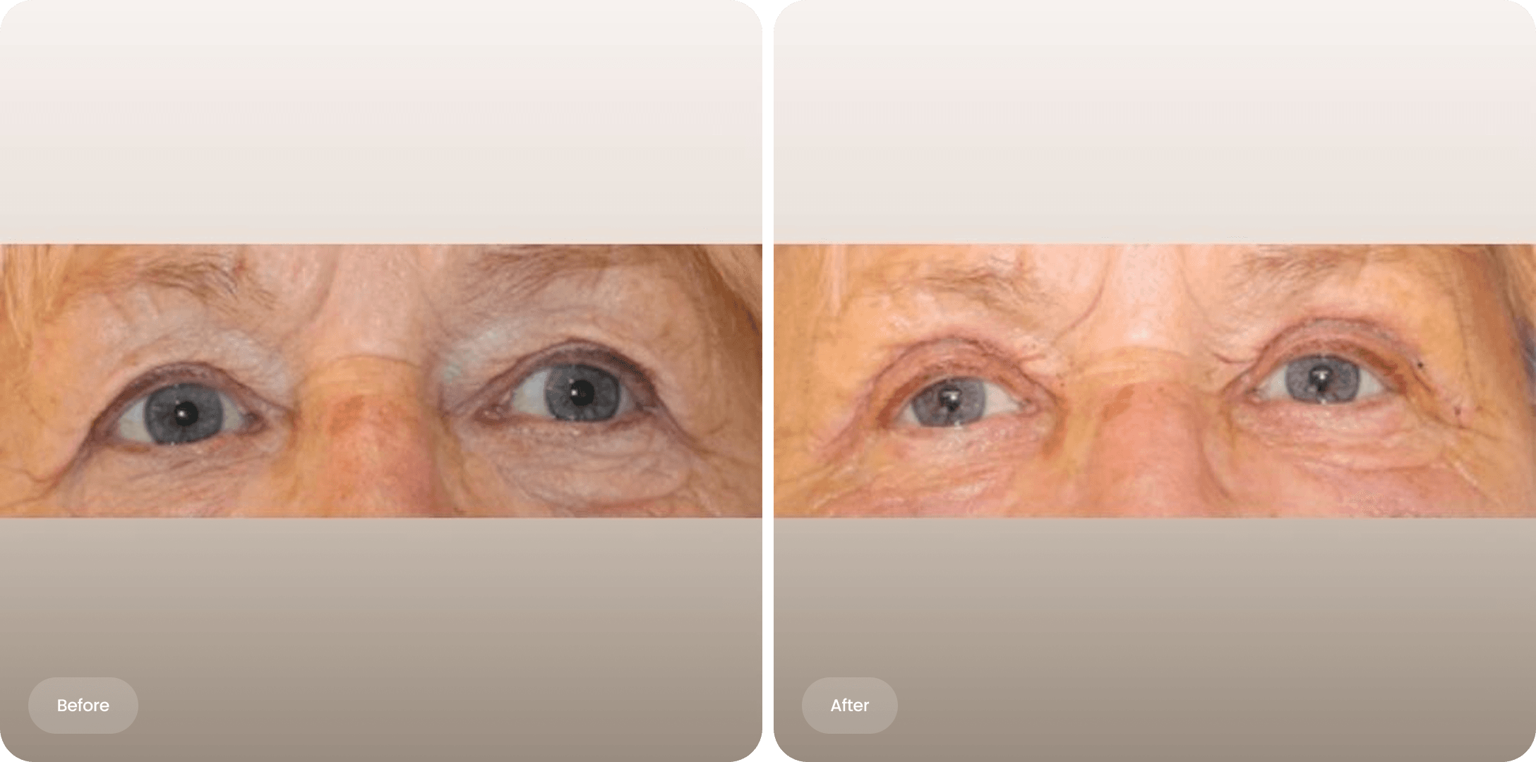 Before and after photo of an upper eyelid correction at The Body Clinic