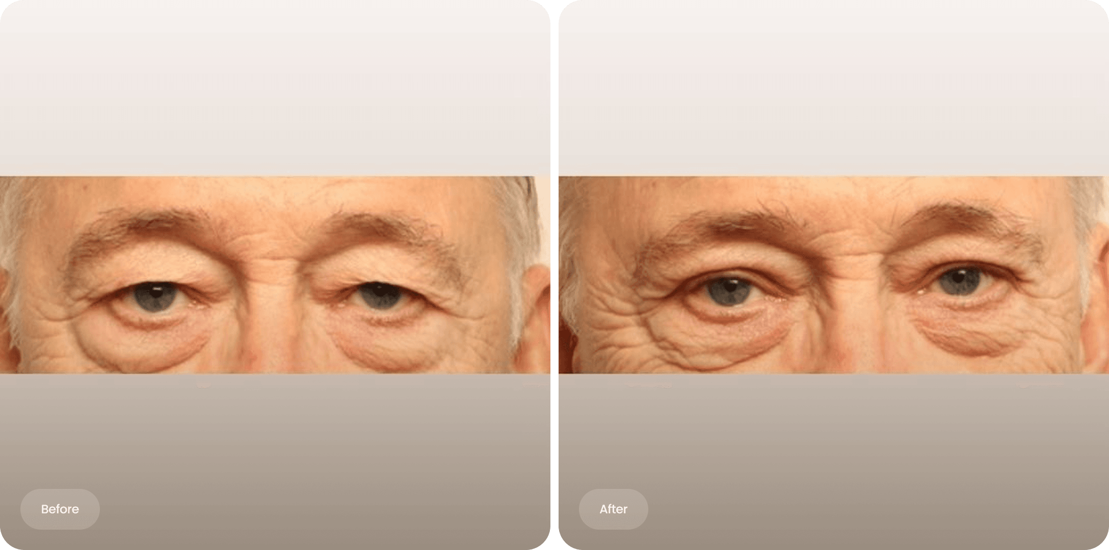 Before and after photo of an upper eyelid correction at The Body Clinic