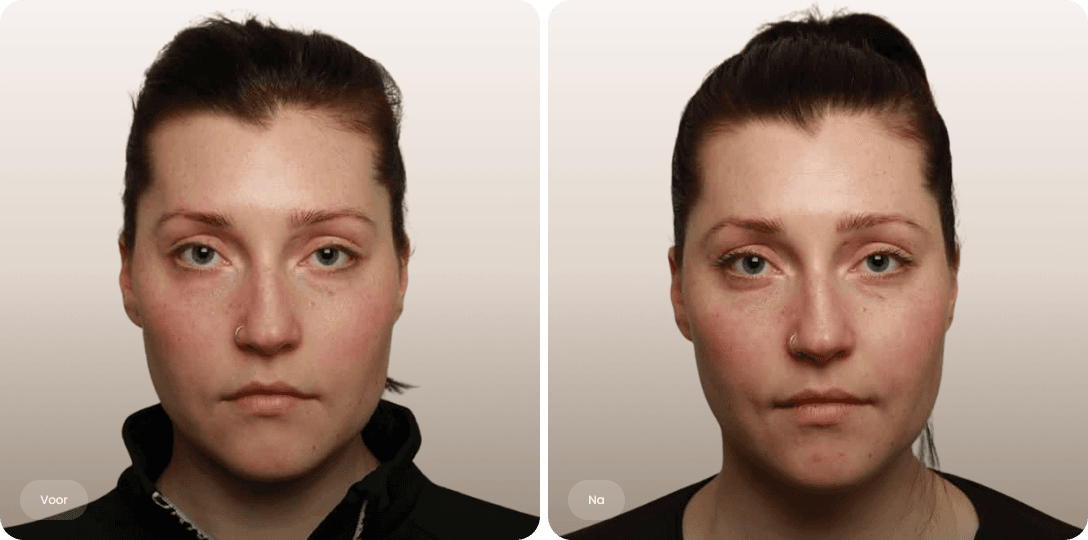 Voor en na foto van fillerbehandeling slapen bij een vrouw voor vollere contouren en een evenwichtiger gezicht bij The Body Clinic