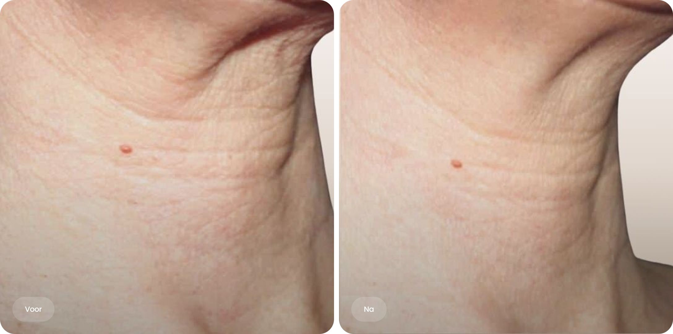 Voor en na resultaat van Profhilo behandeling op de hals bij The Body Clinic