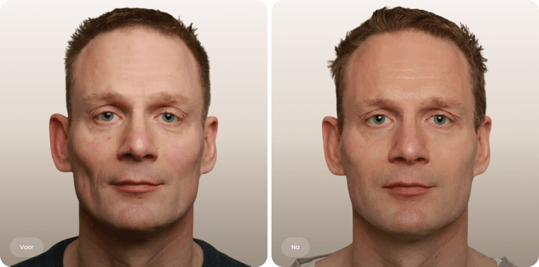 Voor en na foto van liquid facelift met fillers bij een man voor een natuurlijk fris resultaat bij The Body Clinic