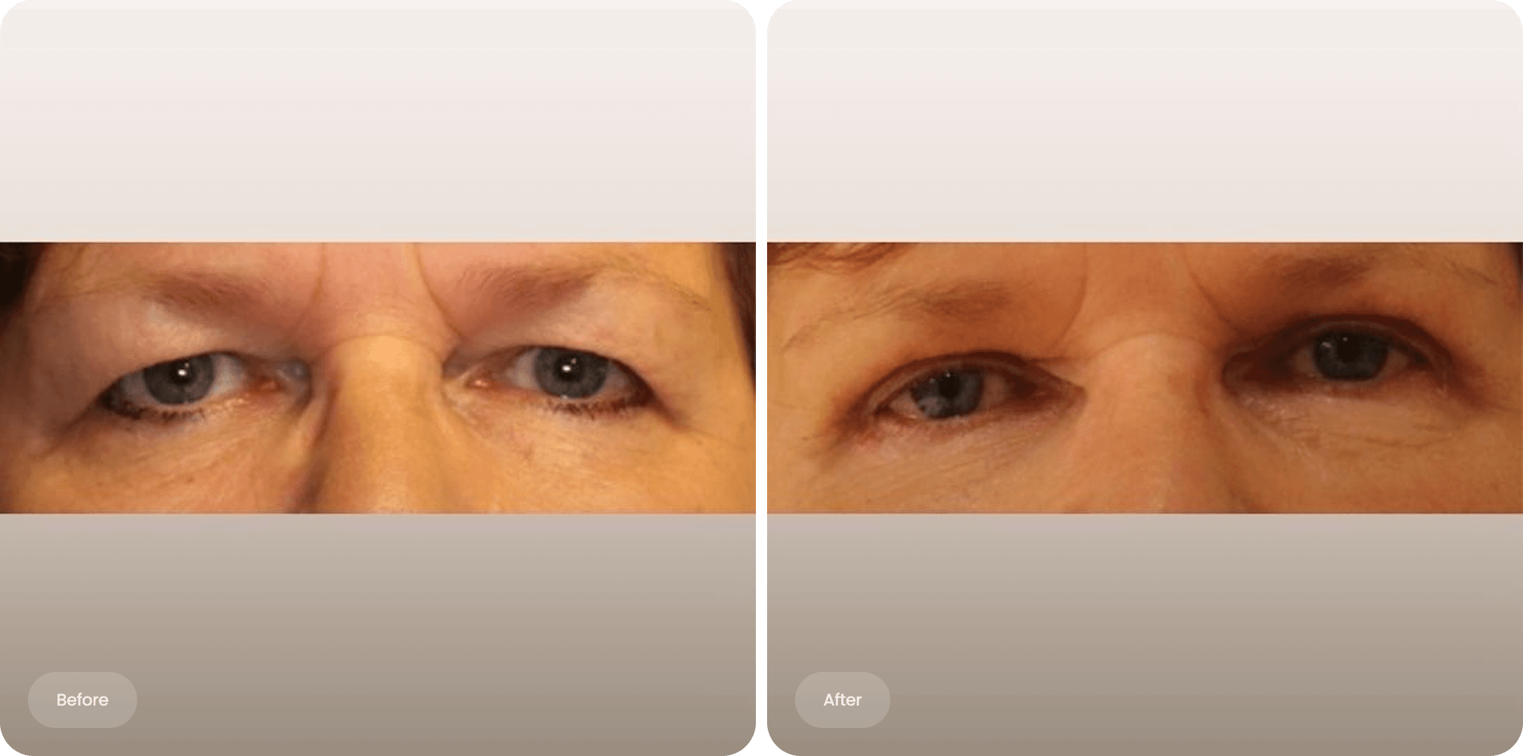 Before and after photo of an upper eyelid correction at The Body Clinic