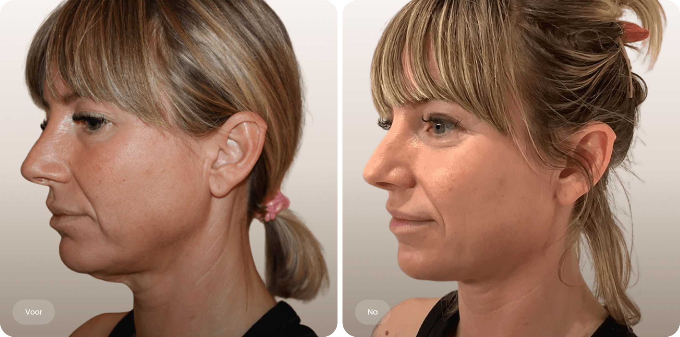 Voor en na foto van NeckTite-behandeling voor een strakkere halslijn en verfijnd profiel bij The Body Clinic