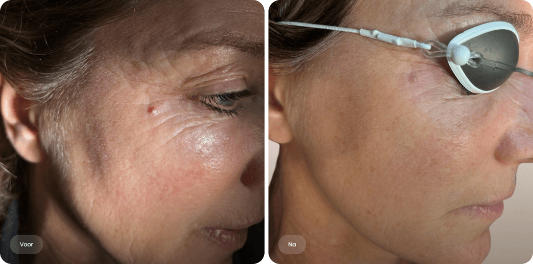 Voor en na foto van lasertherapie tegen couperose bij de ooghoek voor een egale huid zonder zichtbaar vaatje bij The Body Clinic