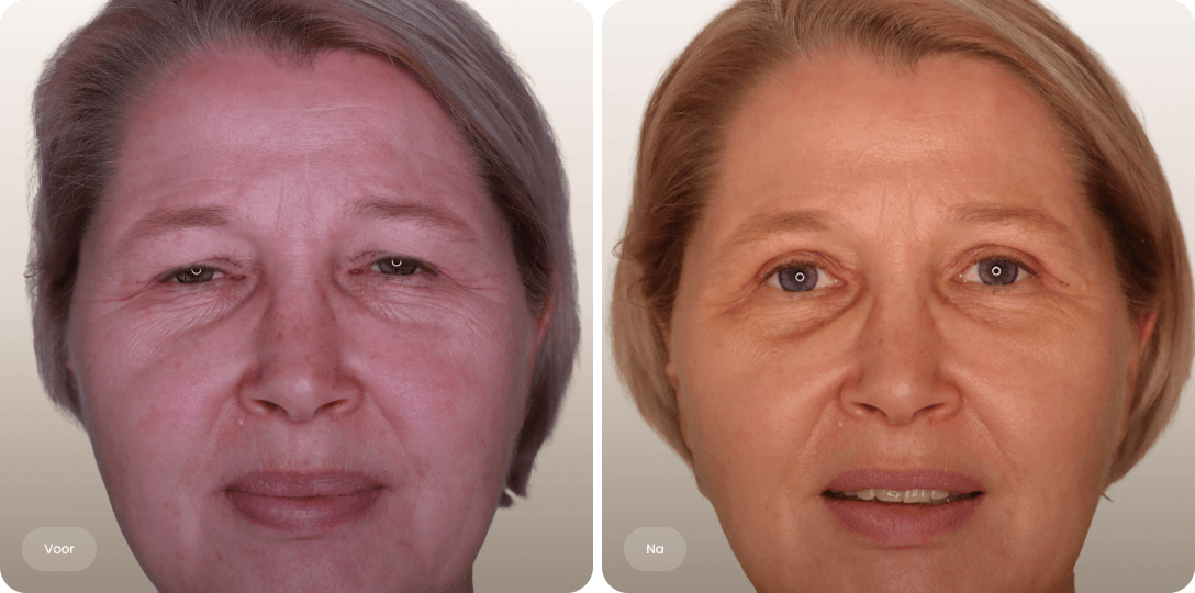 Voor en na foto van ooglidcorrectie bij een vrouw voor een verfriste oogpartij en meer zichtbare ogen bij The Body Clinic