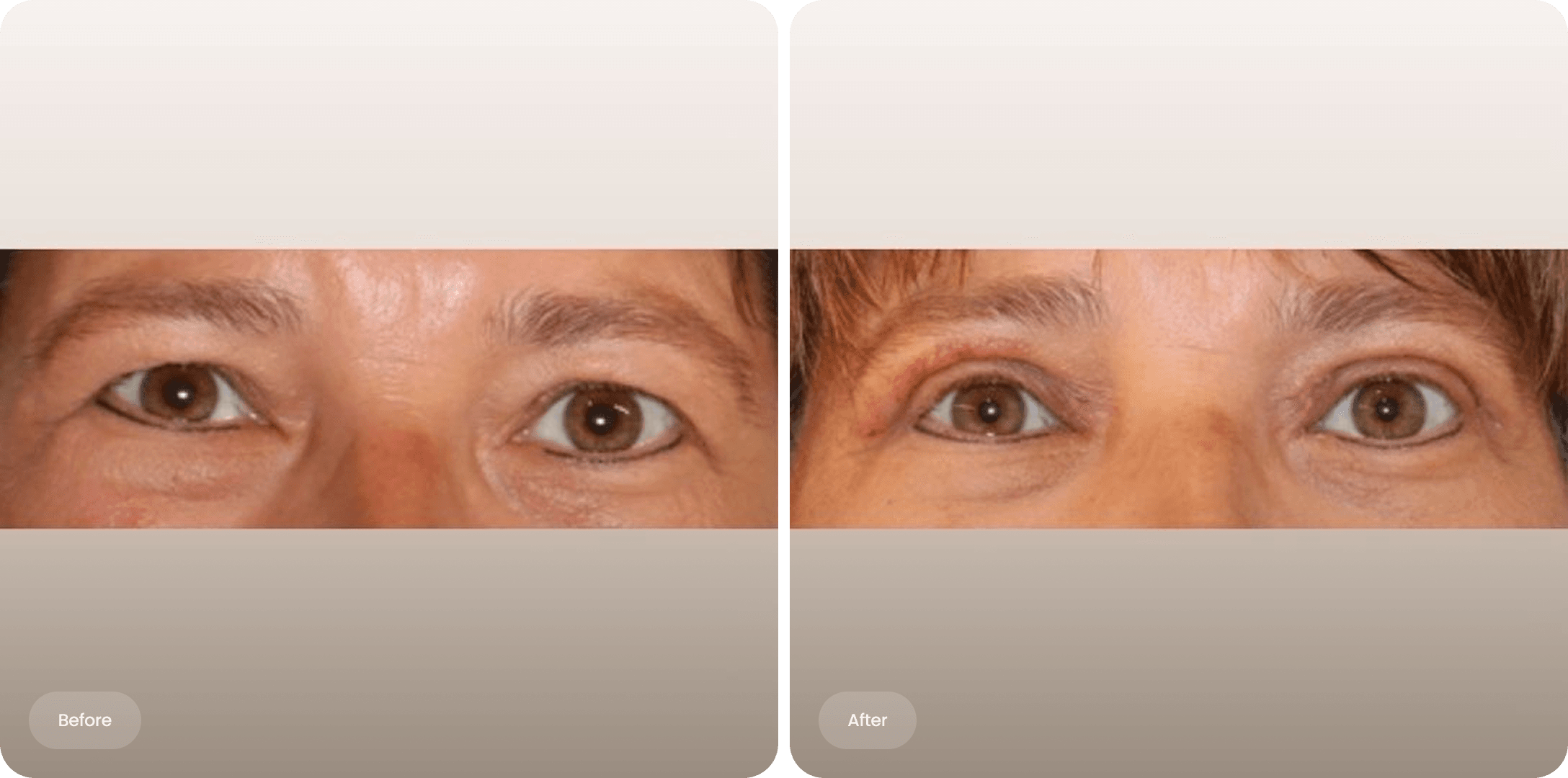 Before and after photo of an upper eyelid correction at The Body Clinic