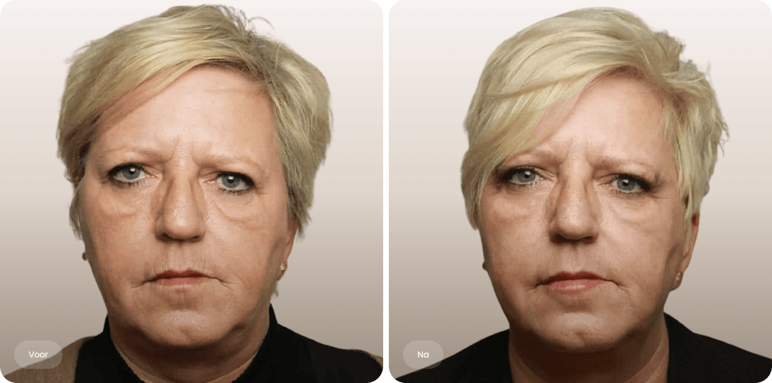 Voor en na foto van Plexr-behandeling liplijntjes voor een gladdere bovenlip bij The Body Clinic