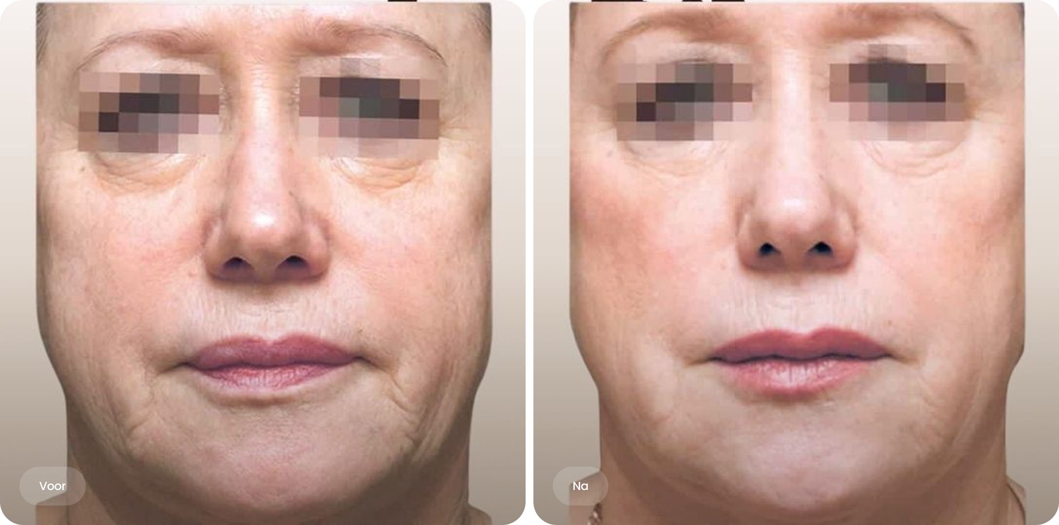 oor en na resultaat van Profhilo behandeling in het gezicht bij The Body Clinic