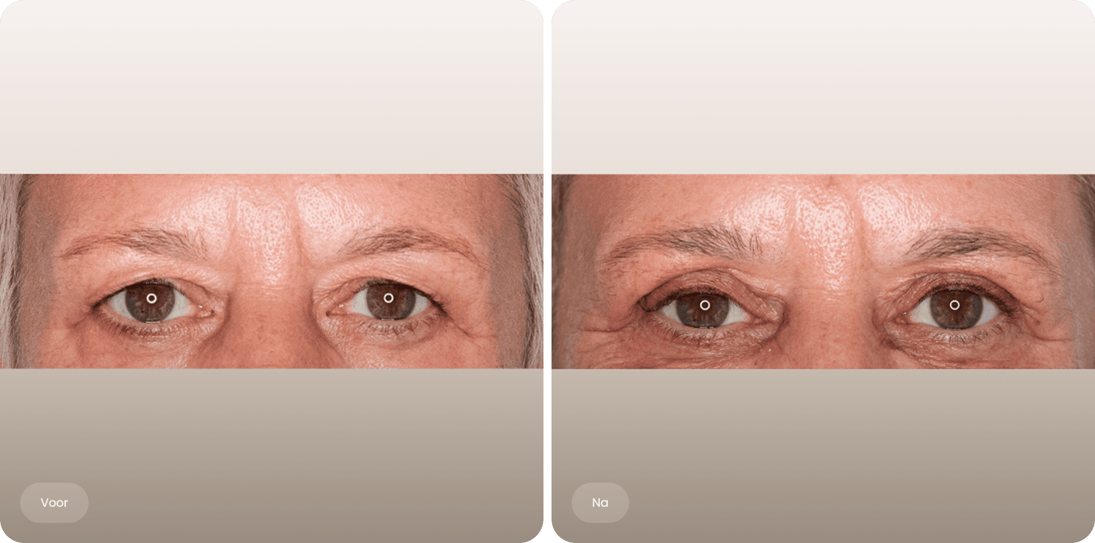 Voor en na foto van bovenooglidcorrectie bij The Body Clinic