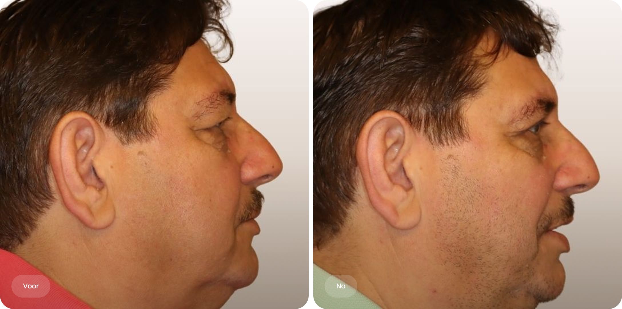 Voor-en-na foto van ooglidcorrectie vanuit zijaanzicht bij The Body Clinic