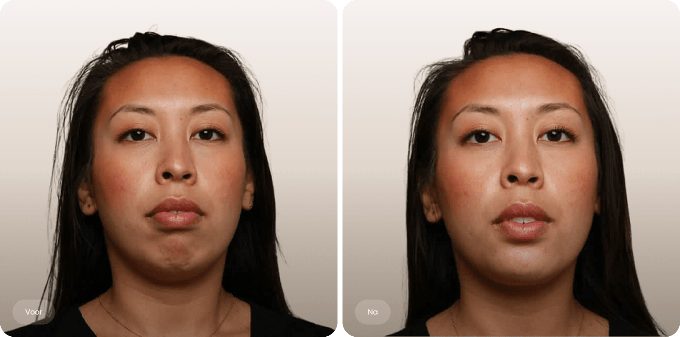 Frontal before and after comparison of an Asian woman with improved jawline definition.